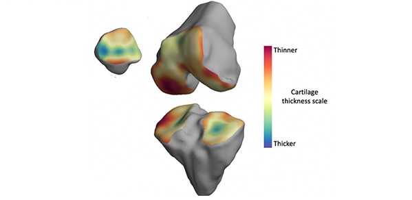 3D model of a knee with osteoarthritis