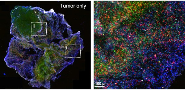  LEFT: A 3D printed tumouroid after 48-hour incubation with immune cells. RIGHT: Zoomed-in section (i) shows the immune cells (in green and red) infiltrating the 3D printed tumouroids.