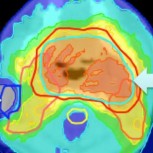 Radiotherapy treatment plan for a head and neck tumour showing colour-shaded dosage areas.
