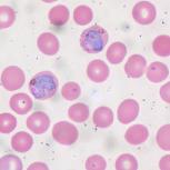 Malaria in peripheral blood