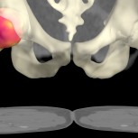 A computer generated image from a medical Computed Tomography X-ray (CT) data set of the hips by Dr Graham Treece