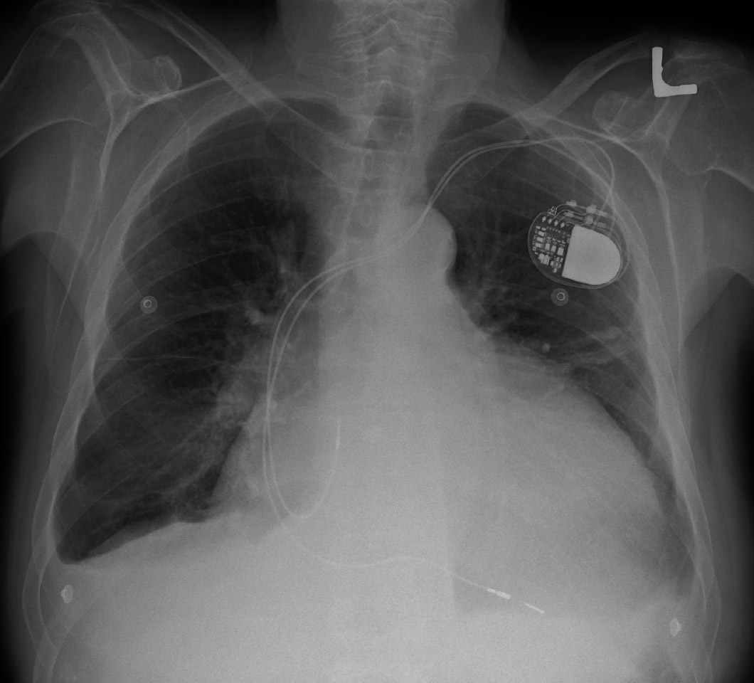 Pacemakers are the most common implantable device today