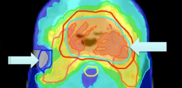 Radiotherapy treatment plan for a head and neck tumour showing colour-shaded dosage areas.