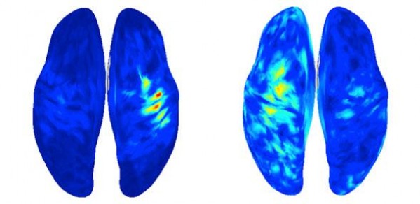 Measurement of brain activity in a patient with phantom limb pain