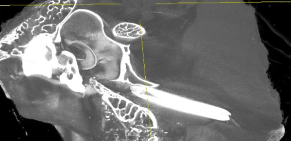 The BET procedure: A balloon catheter is inserted into the Eustachian tube via the nose. It is then inflated to a high pressure. The image shows an x-ray image of the procedure.