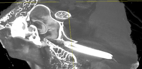 The BET procedure: A balloon catheter is inserted into the Eustachian tube via the nose. It is then inflated to a high pressure. The image shows an x-ray image of  the procedure. 