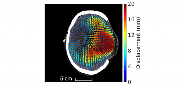 Analysis of shear strain on brain having undergone decompressive craniectomy