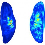 Measurement of brain activity in a patient with phantom limb pain